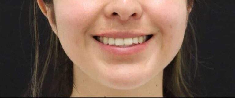 After Image: Lip Filler + Lip Flip - front