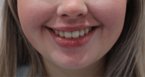 After Image: Lip Filler