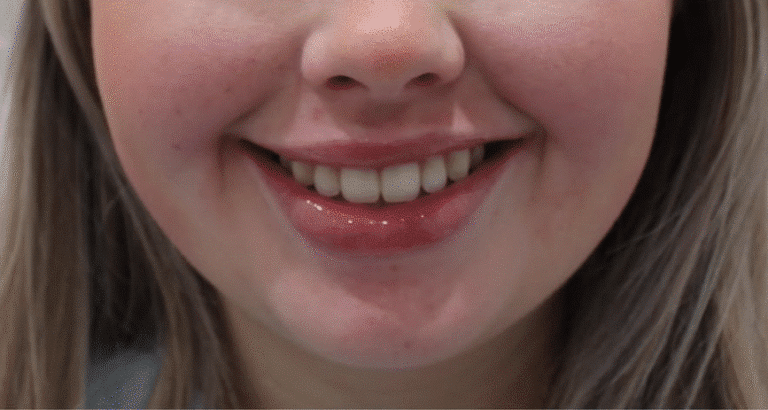 After Image: Lip Filler - front
