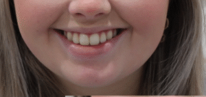 Before Image: Lip Filler