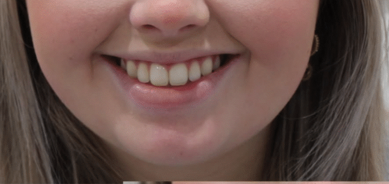 Before Image: Lip Filler - front