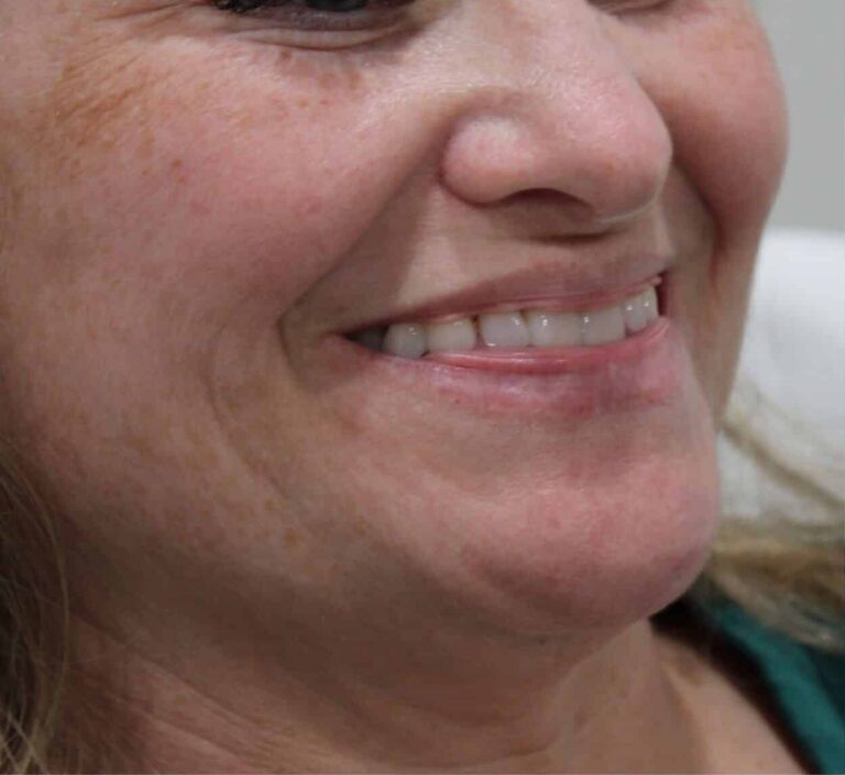 Before Image: Lip Filler - front
