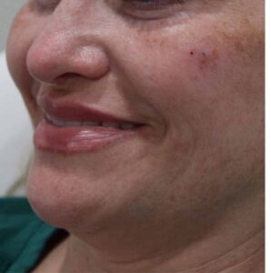 After Image: Lip Filler