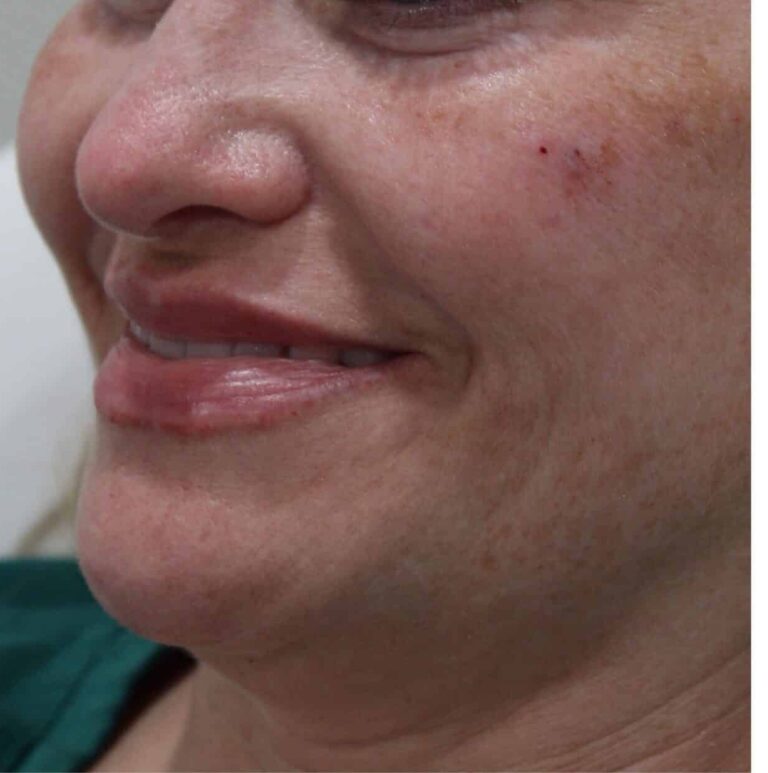 After Image: Lip Filler - front