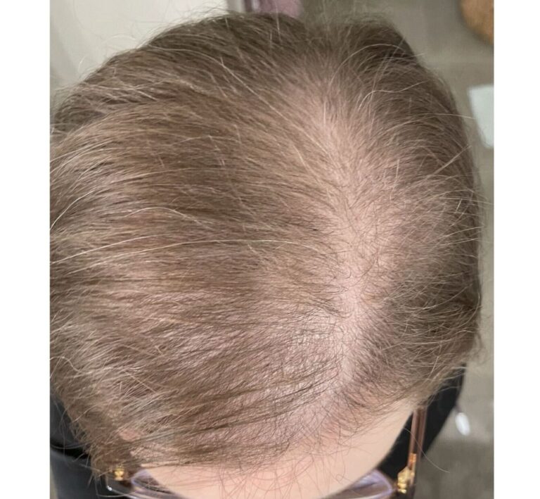 After Image: Hair Restoration - front