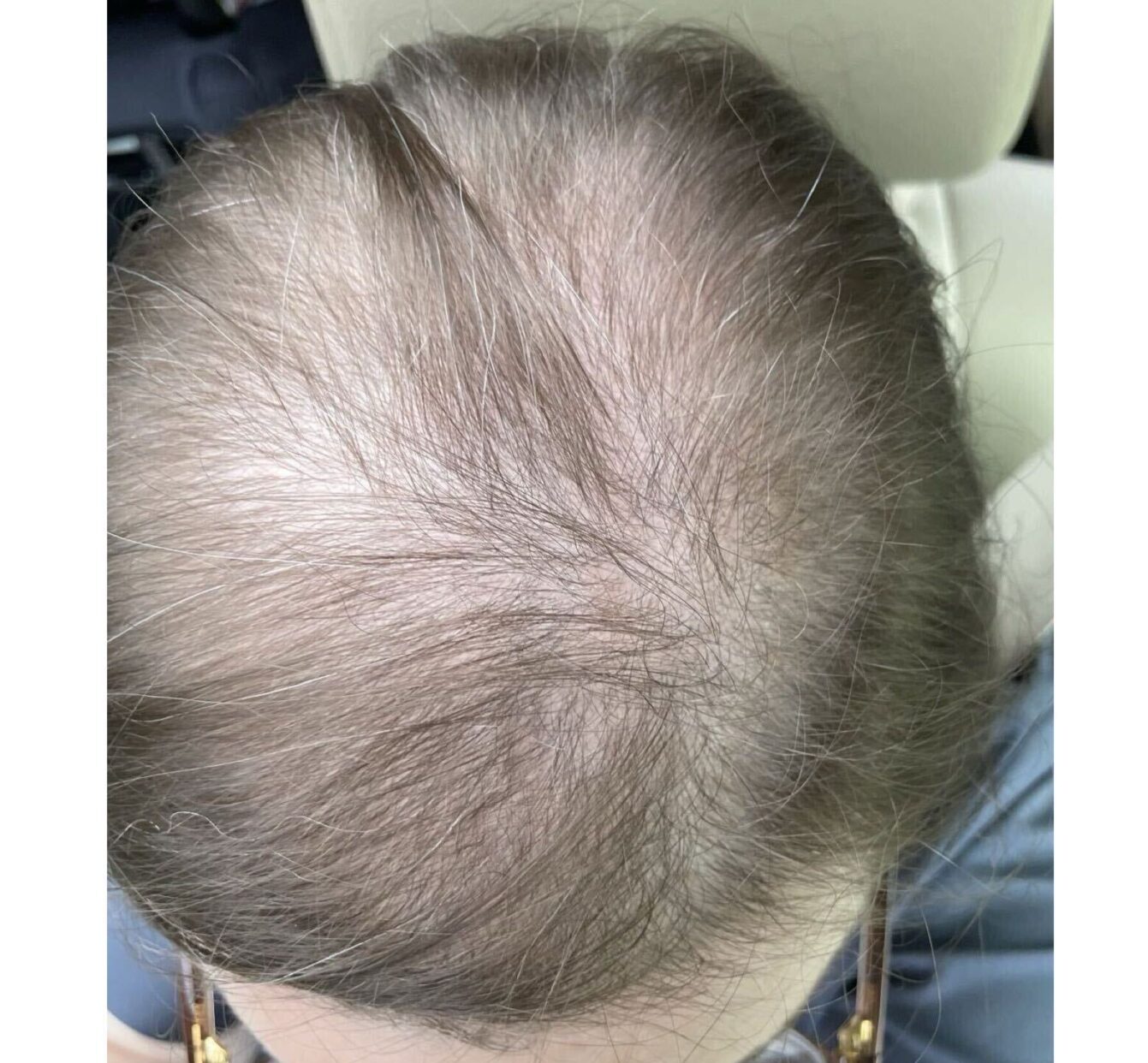 Before Image: Hair Restoration - front