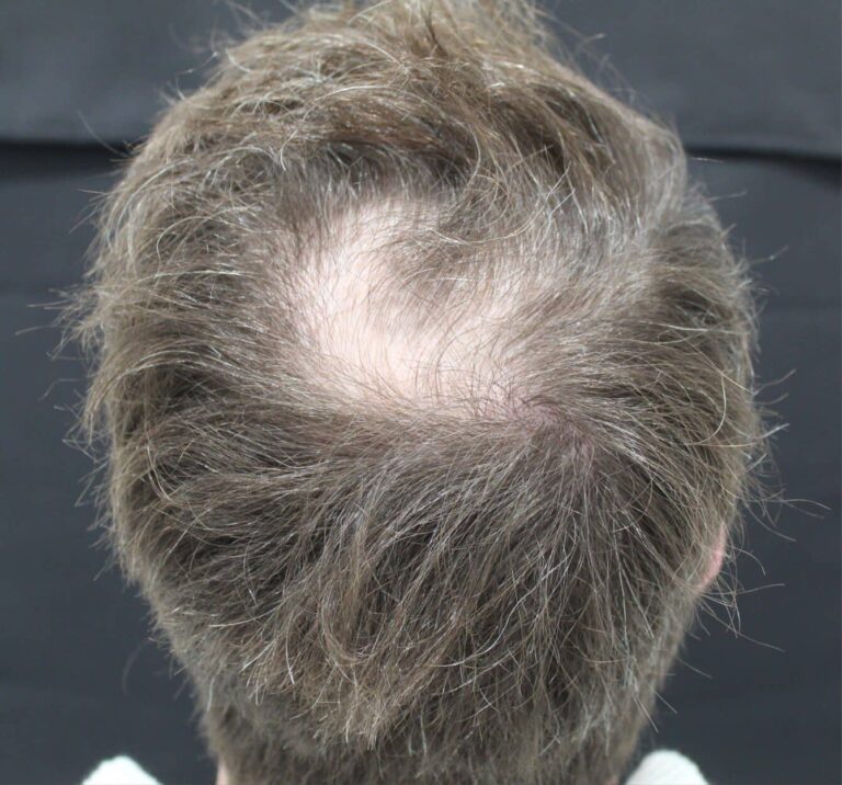 Before Image: Hair Restoration - front