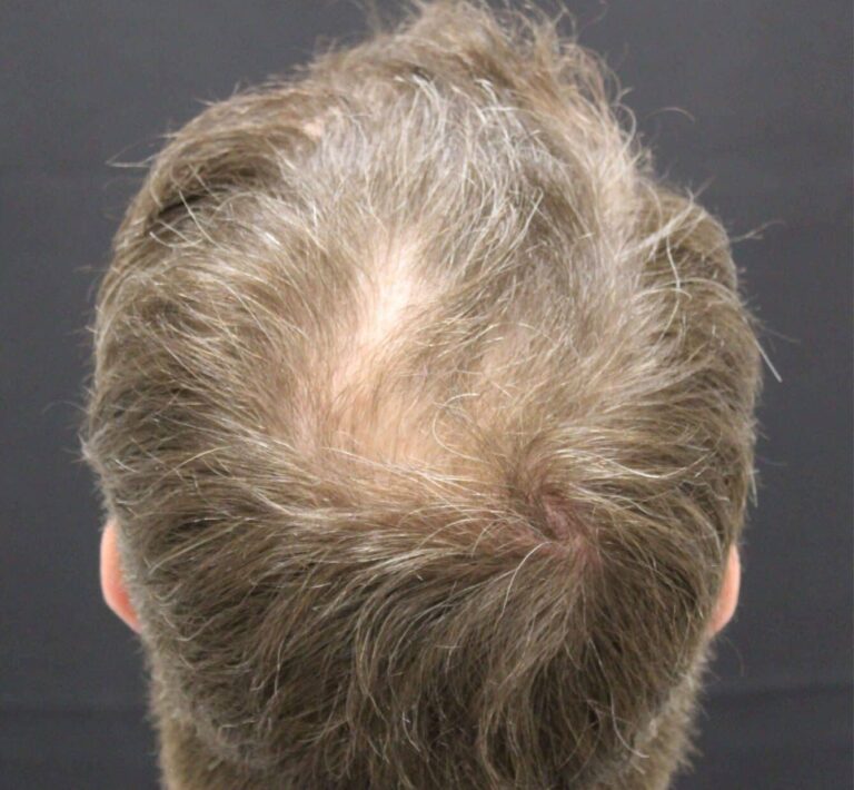 After Image: Hair Restoration - front