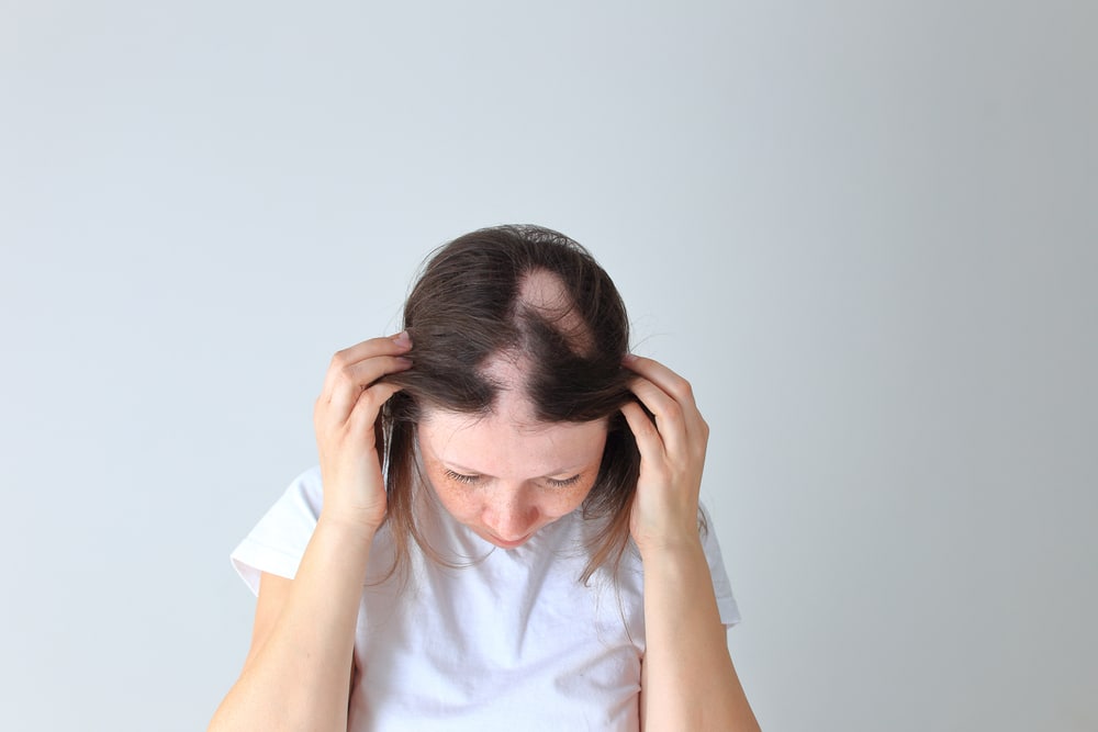 Woman looking down to show her bald spots, in need of Neograft hair restoration treatment.