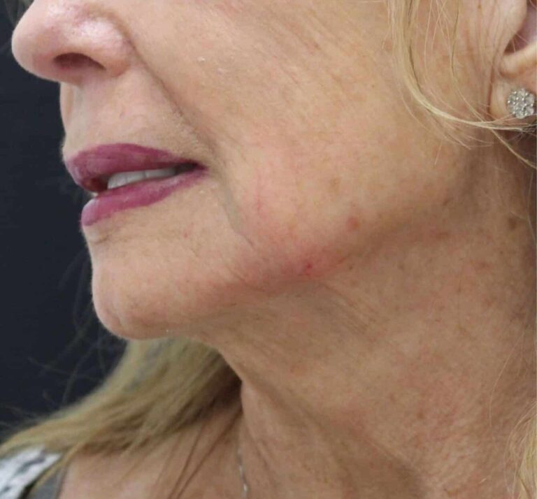 After Image: Jawline Filler - front