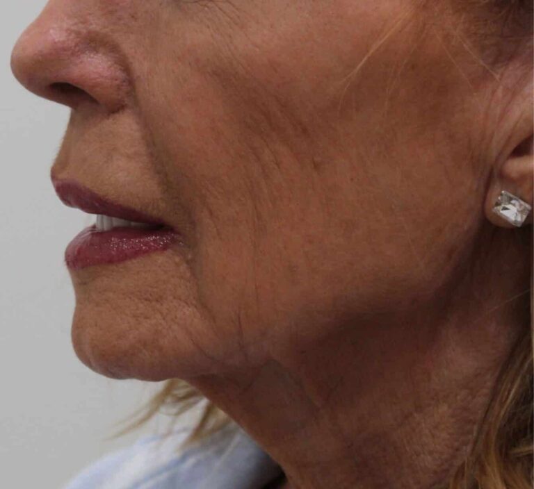 Before Image: Jawline Filler - front