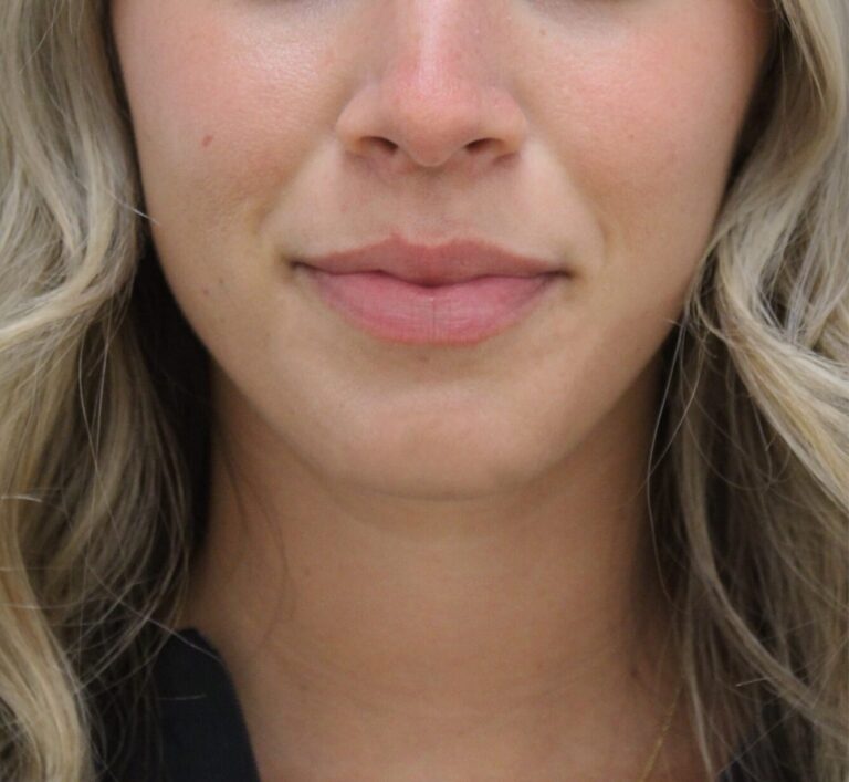 Before Image: Lip Filler - front