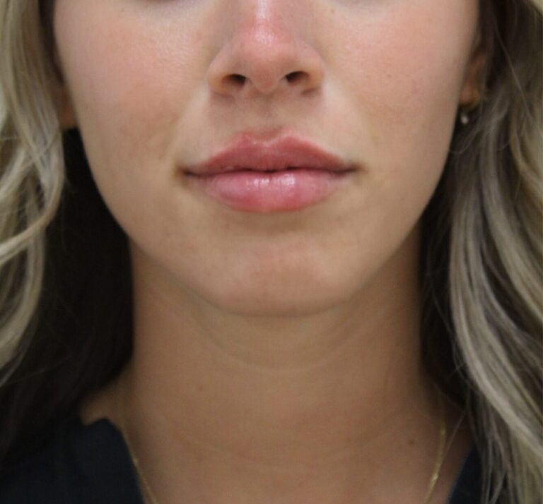 After Image: Lip Filler - front