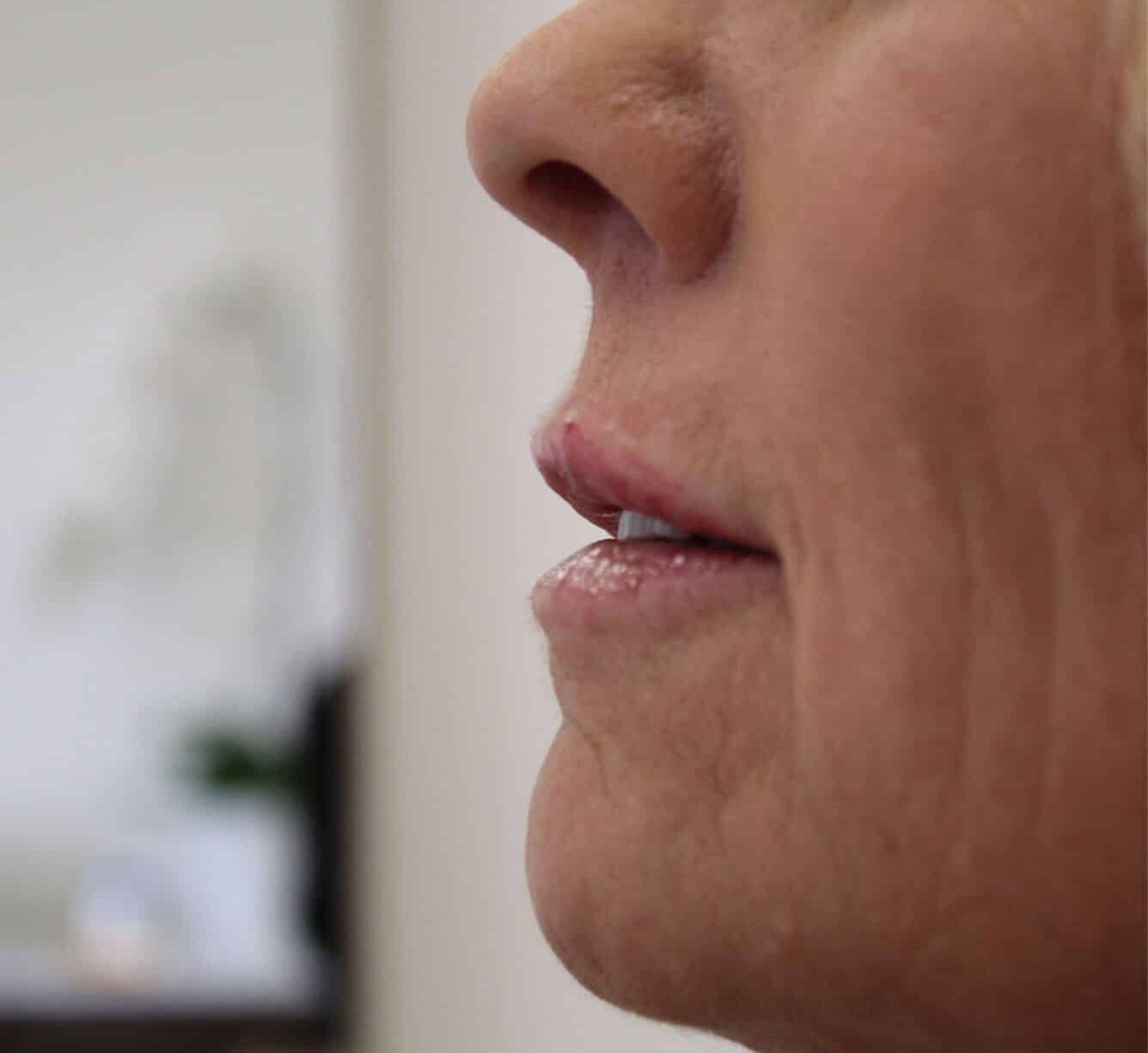 After Image: Lip Filler - front