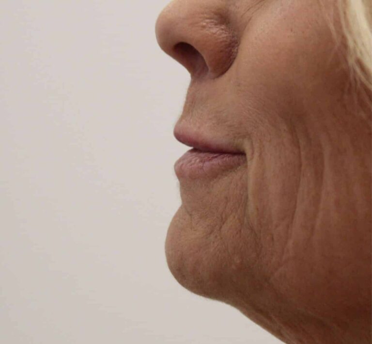 Before Image: Lip Filler - front