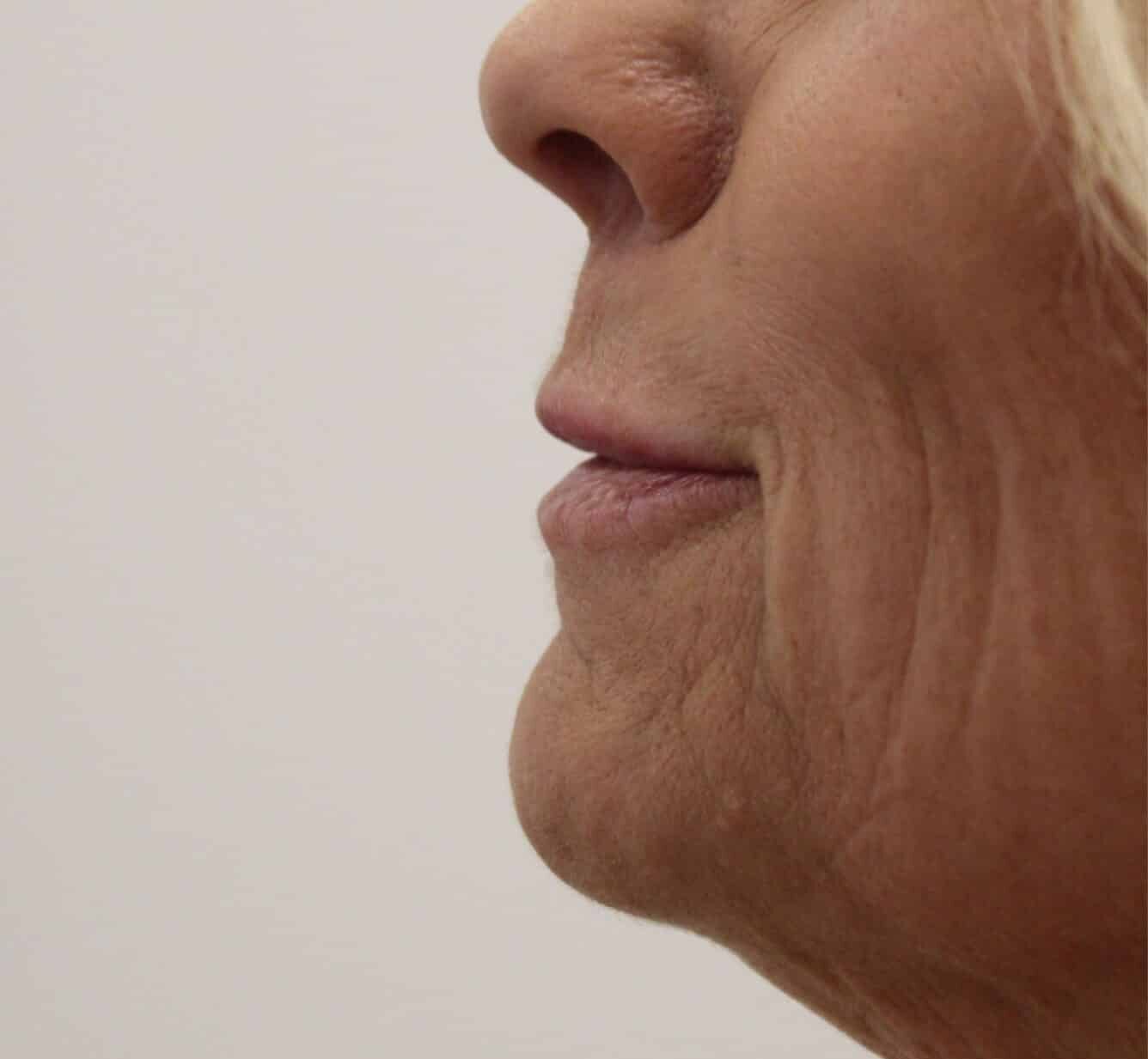 Before Image: Lip Filler - front