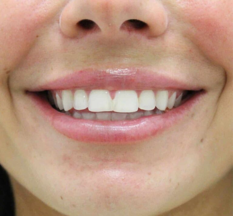 Before Image: Lip Filler - front