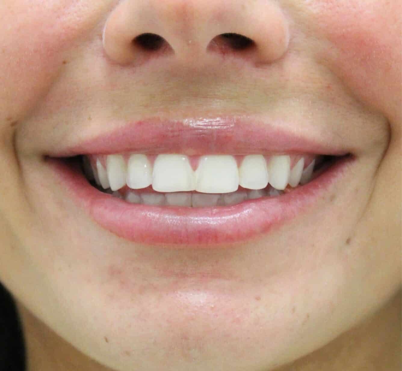 Before Image: Lip Filler - front