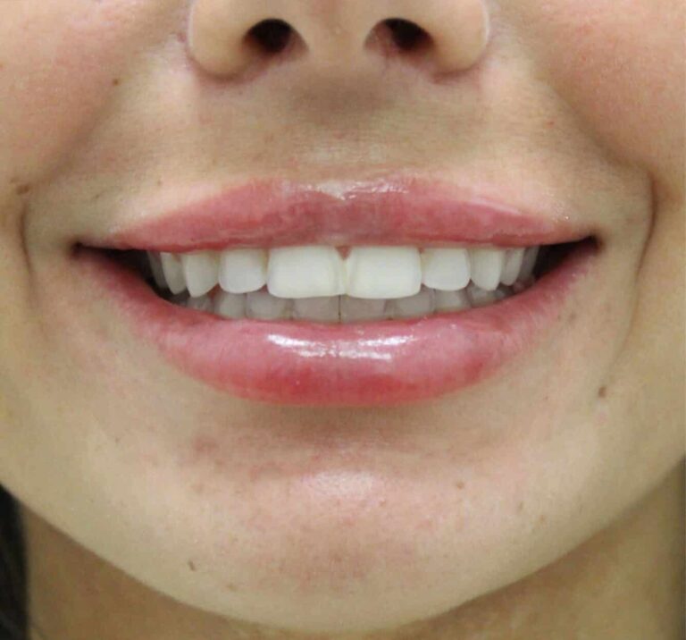 After Image: Lip Filler - front