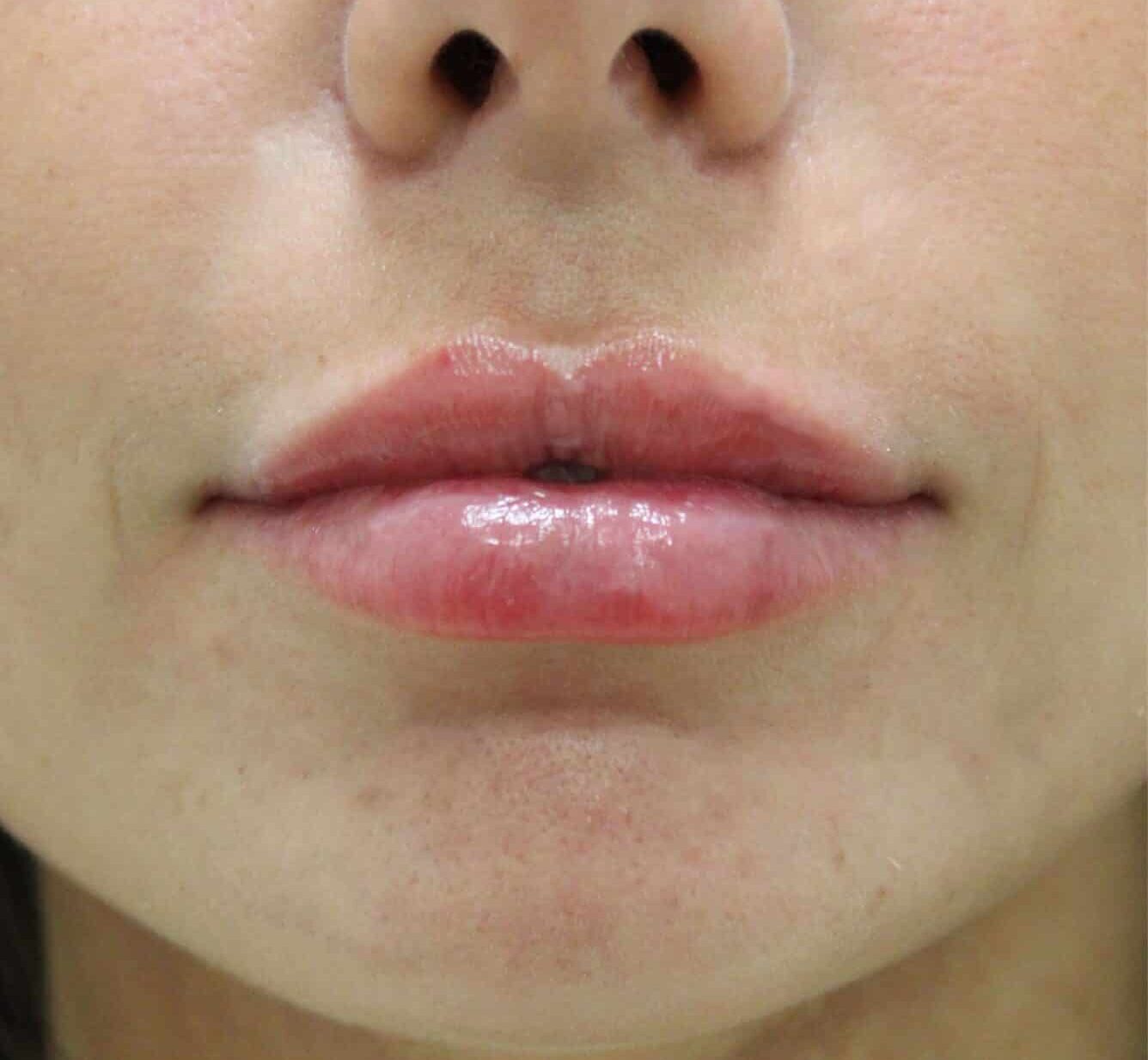 After Image: Lip Filler - front