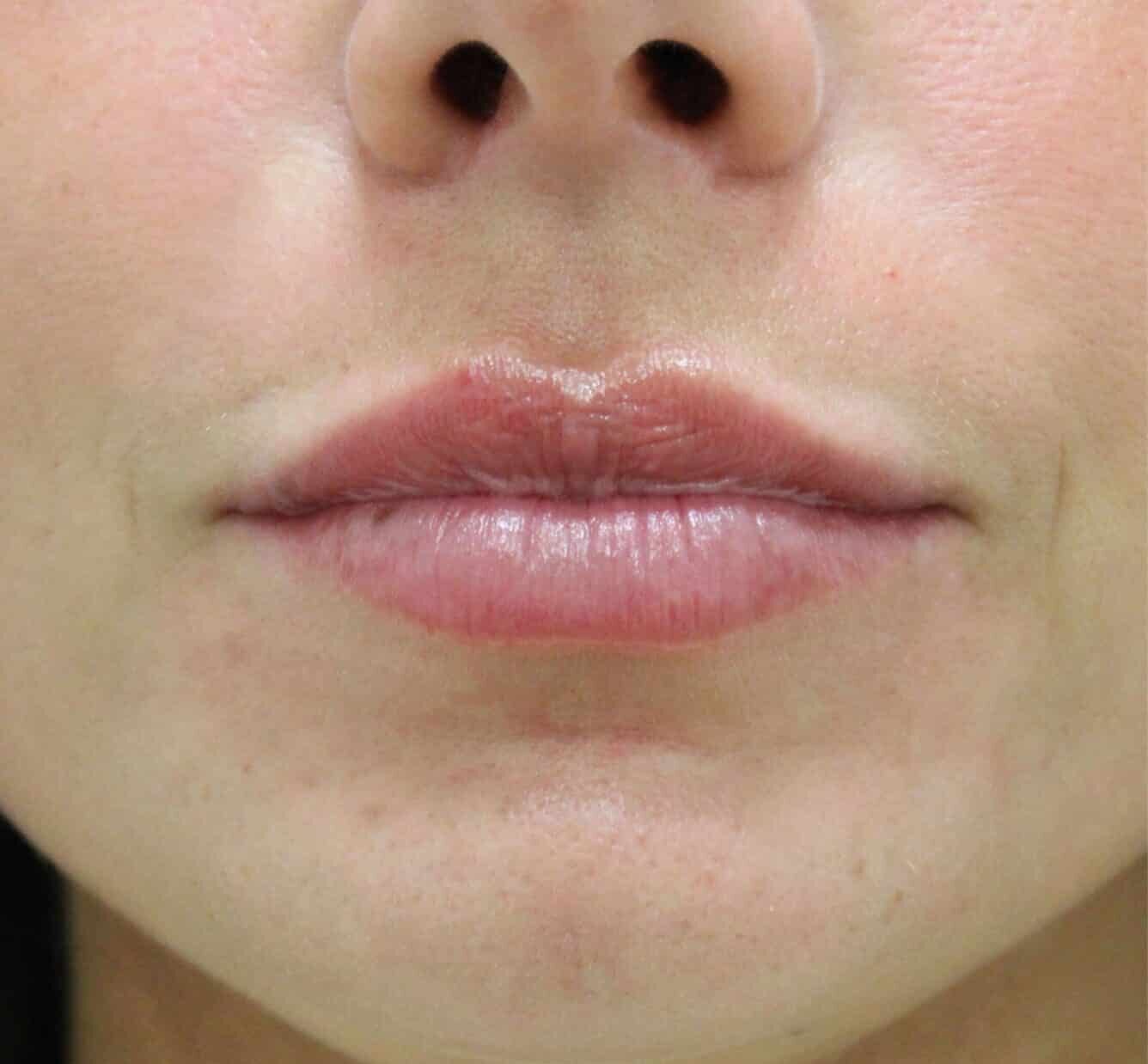 Before Image: Lip Filler - front