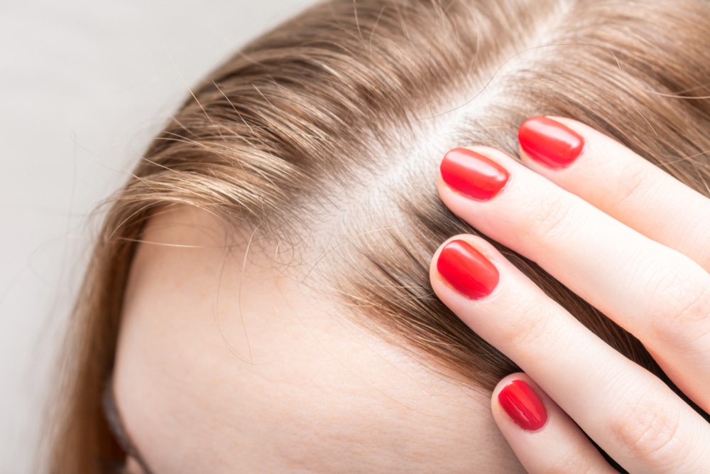 Close up of a woman's scalp, showing her hair loss and in need of PRP treatment.