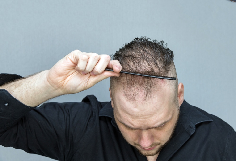 Middle-aged man looking down while combing his hair and showing us how it's thinning, in need of NeoGraft.