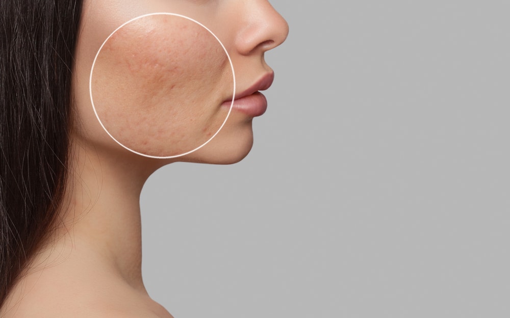 Close up of a woman's face with acne scarring, in need of SkinPen Microneedling to help repair her skin.