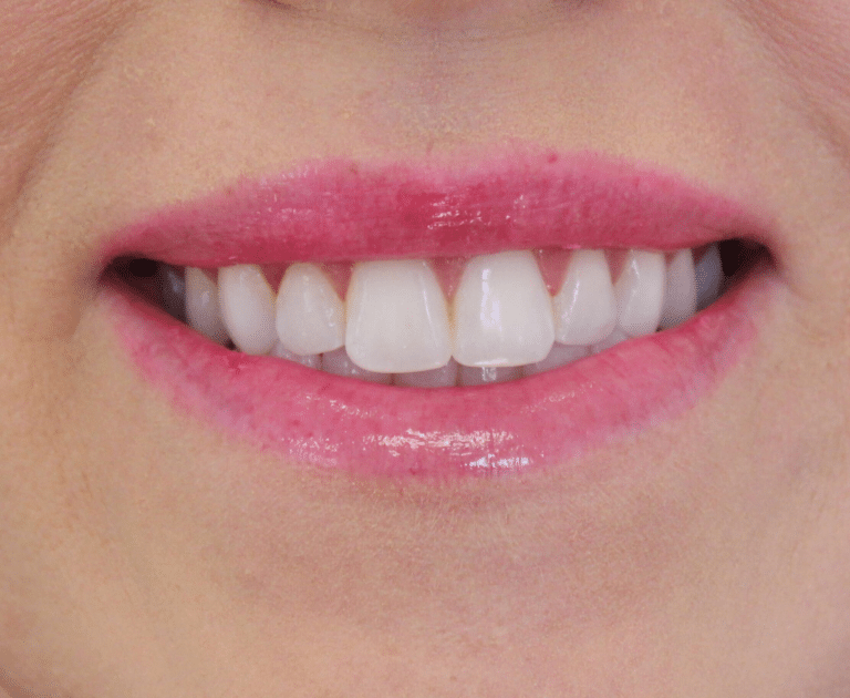 After Image: Neurotoxin Lip Flip - front
