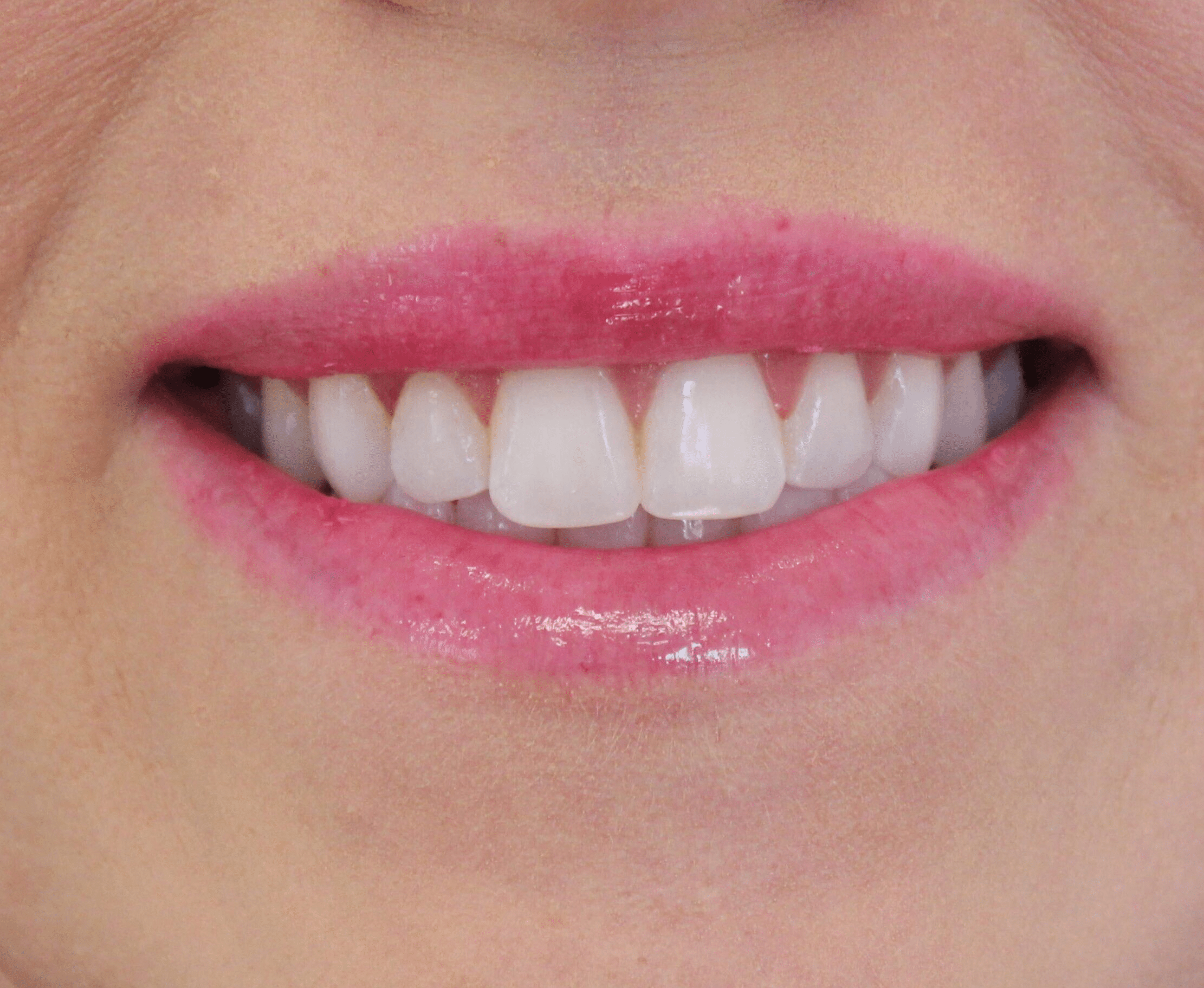 After Image: Neurotoxin Lip Flip - front