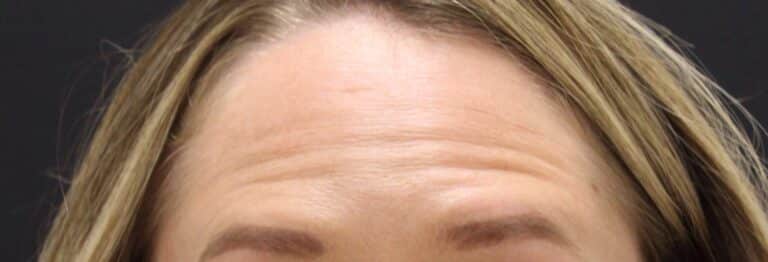 Before Image: Neurotoxin - front