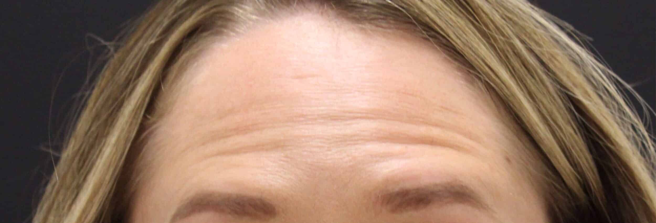 Before Image: Neurotoxin - front