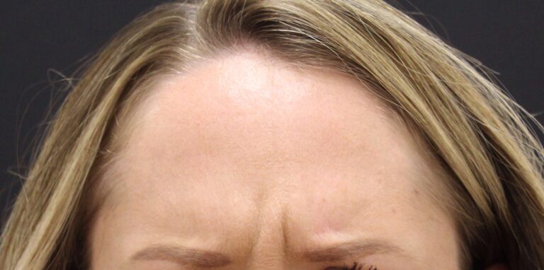 Before Image: Neurotoxin - front