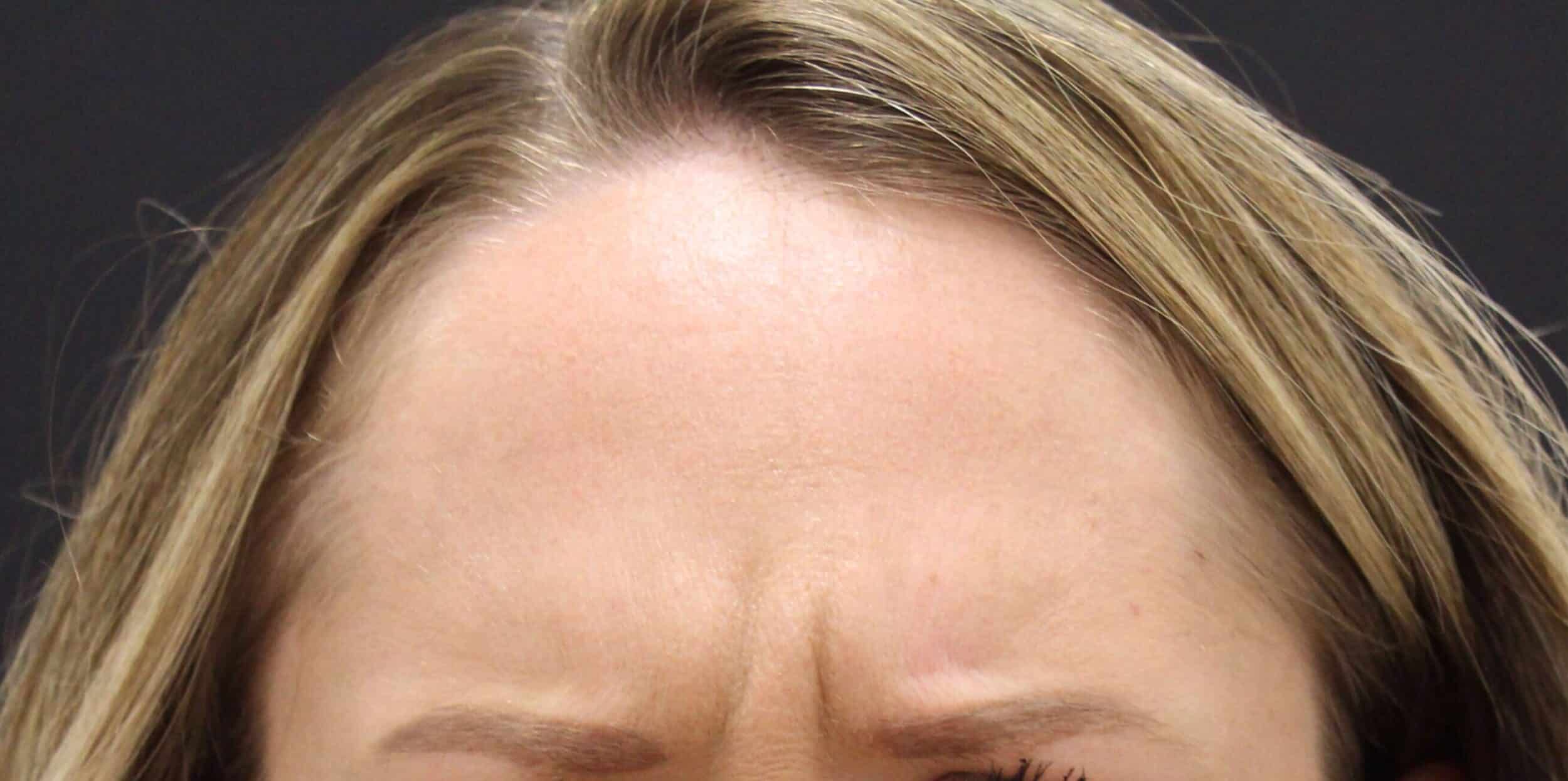 Before Image: Neurotoxin - front