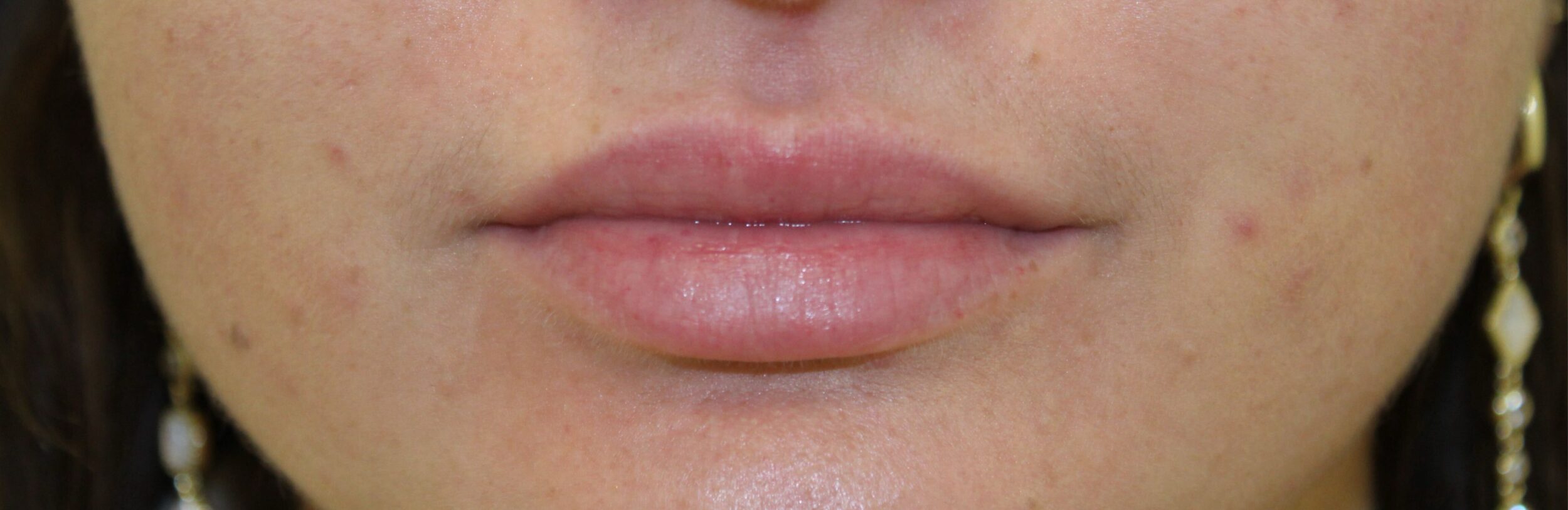 Before Image: Lip Filler - front