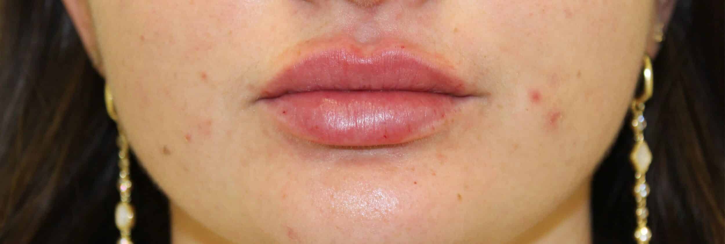 After Image: Lip Filler - front