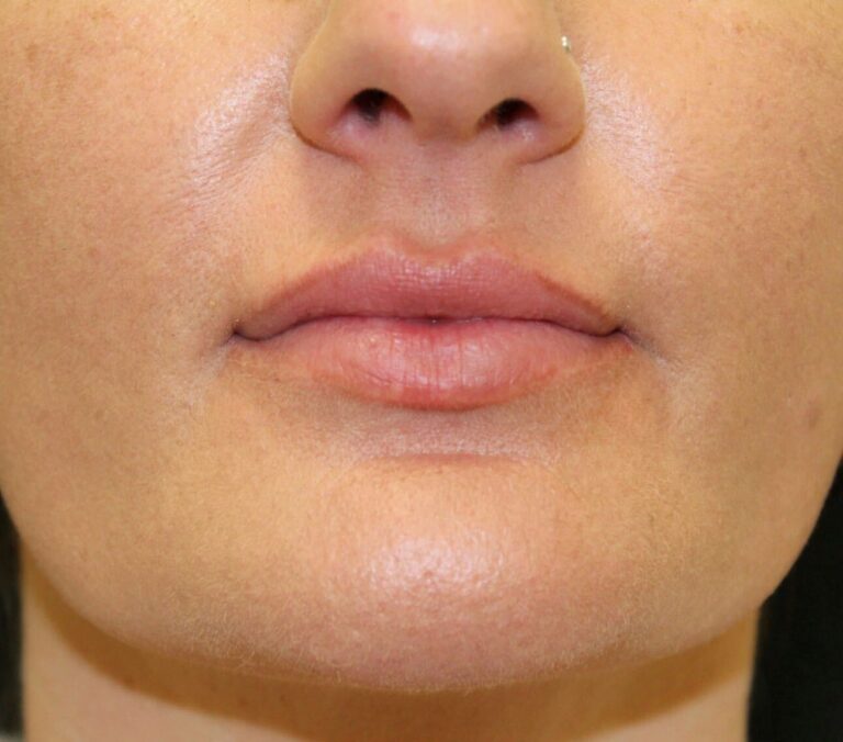 Before Image: Lip Filler - front