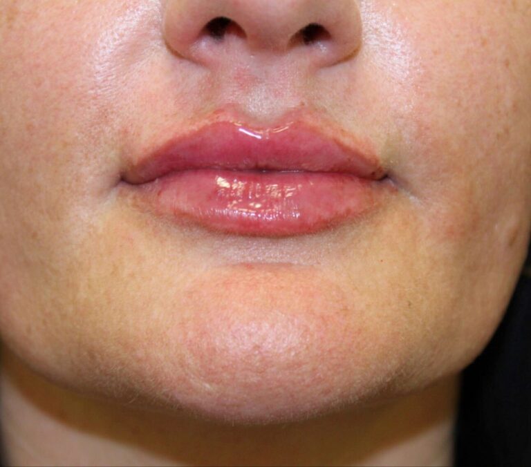After Image: Lip Filler - front