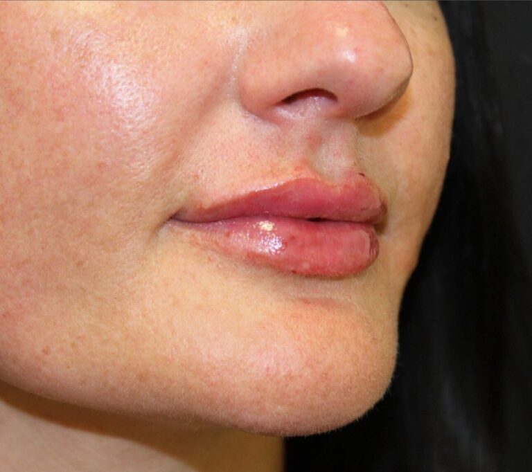 After Image: Lip Filler -
