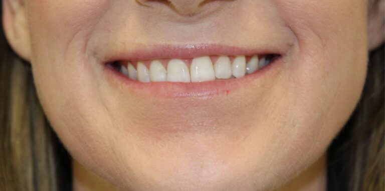 Before Image: Lip Flip + Lip Filler - front