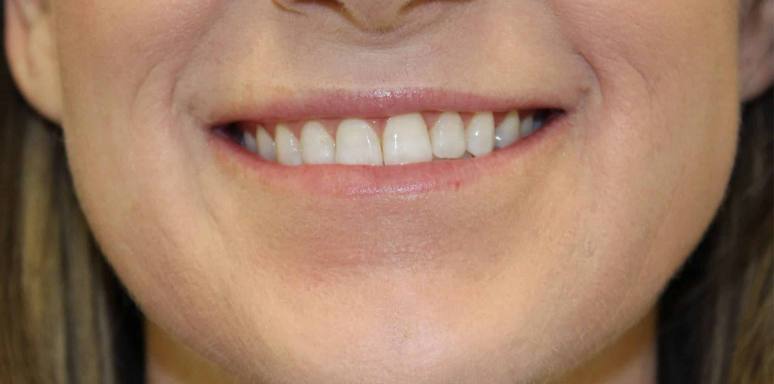 Before Image: Lip Flip + Lip Filler - front