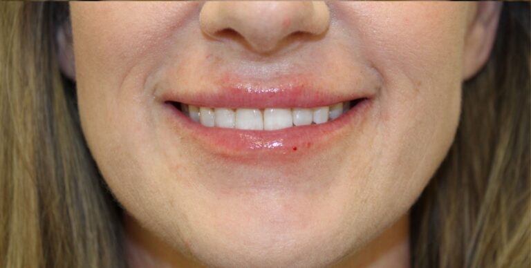 After Image: Lip Flip + Lip Filler - front
