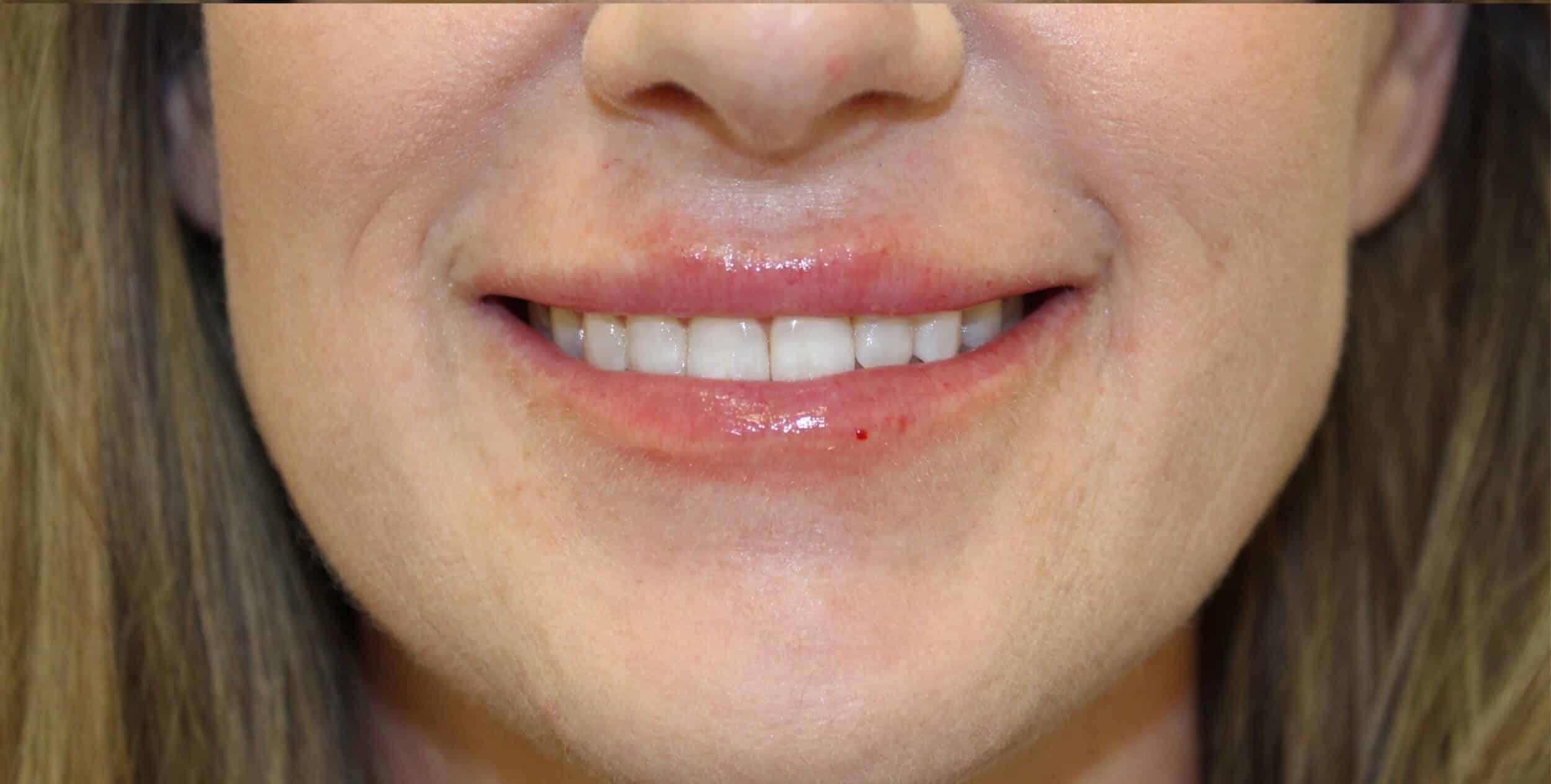 After Image: Lip Flip + Lip Filler - front