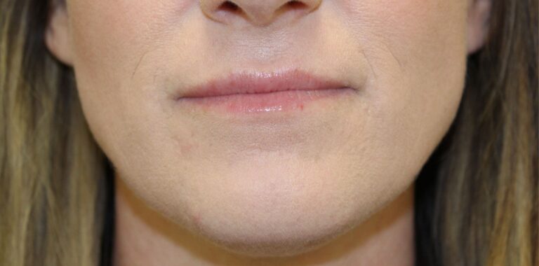 Before Image: Lip Flip + Lip Filler - front