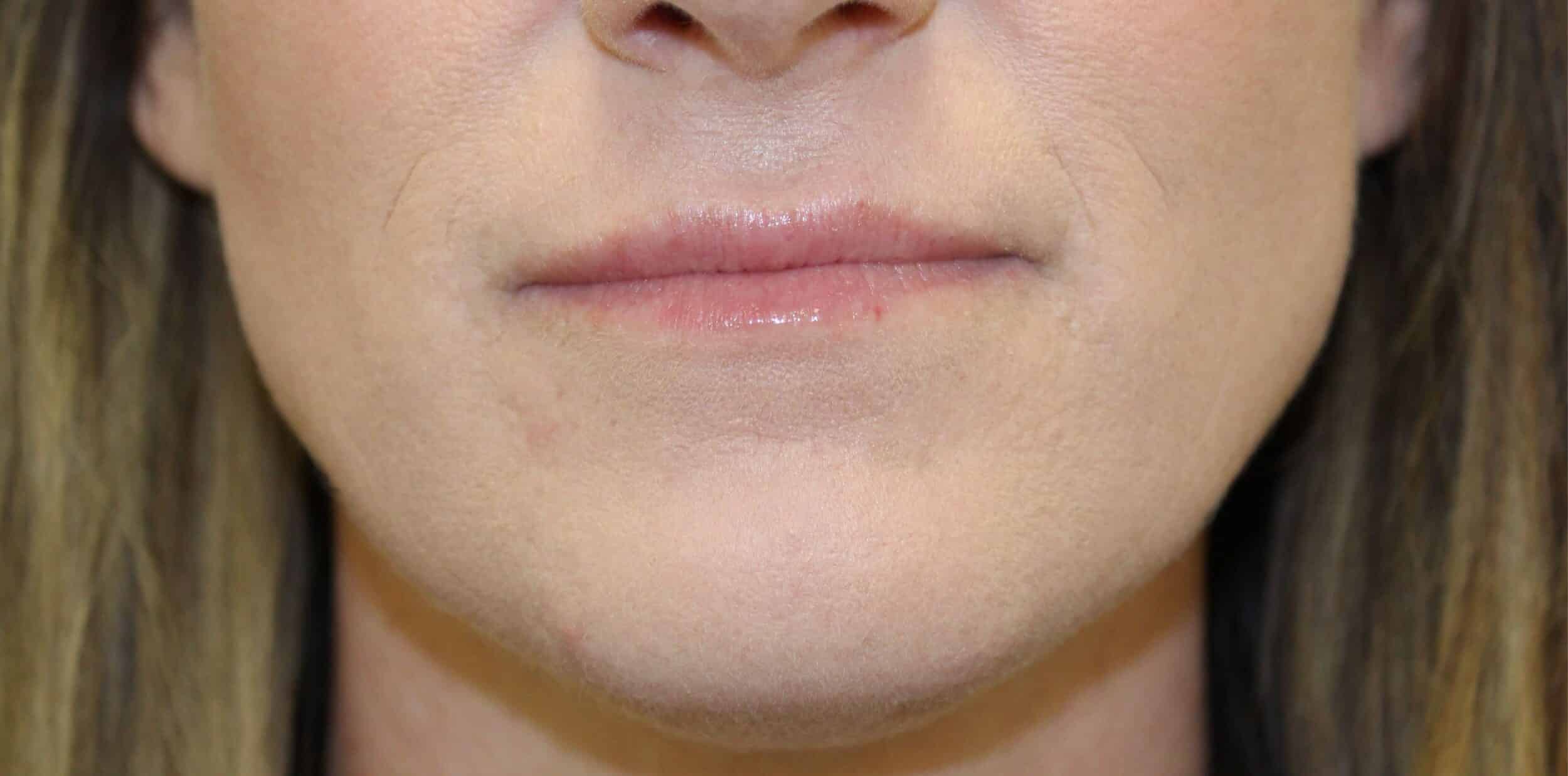 Before Image: Lip Flip + Lip Filler - front