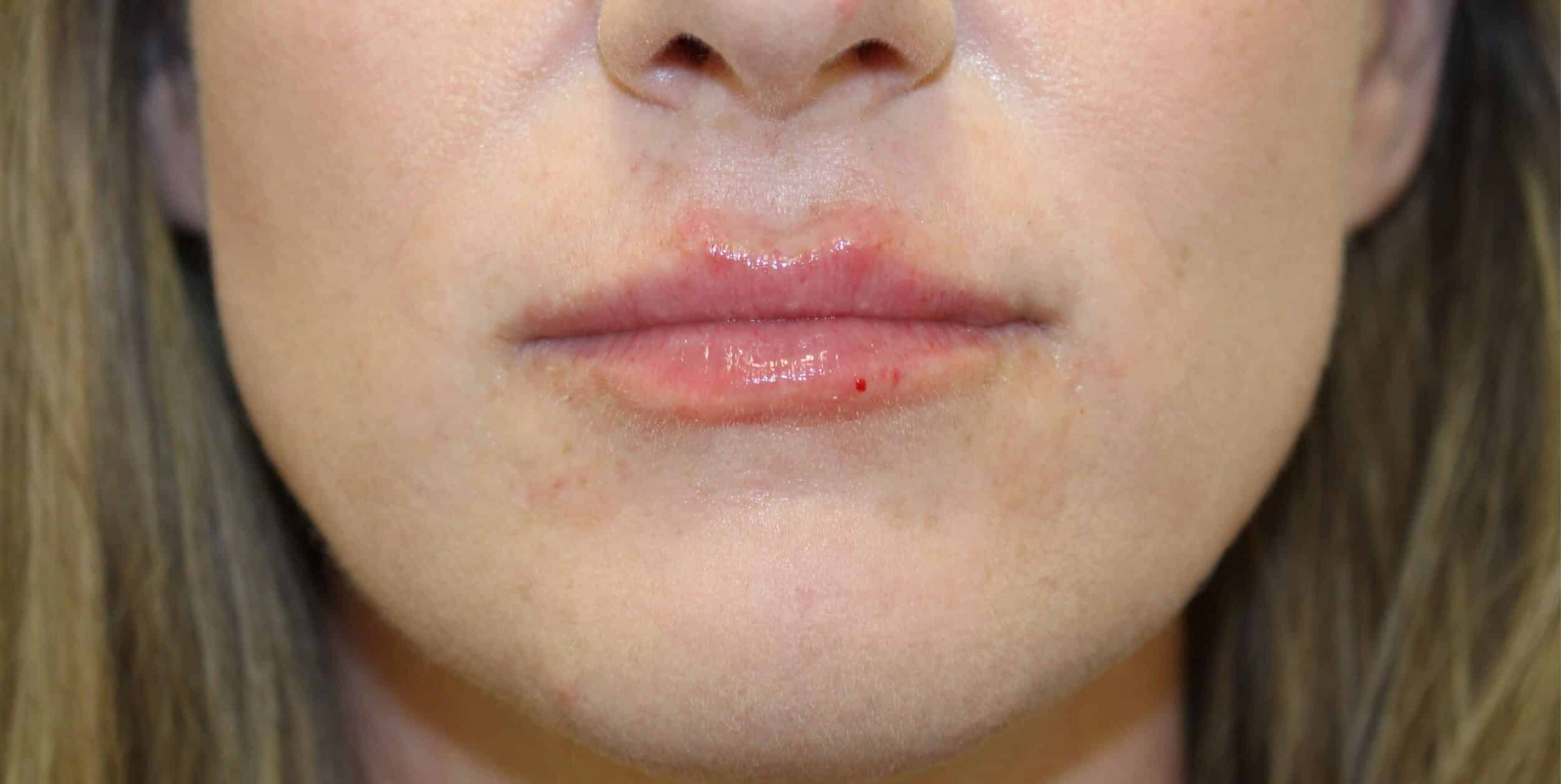 After Image: Lip Flip + Lip Filler - front