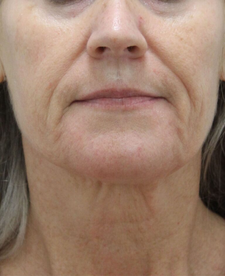 Before Image: Sculptra - front