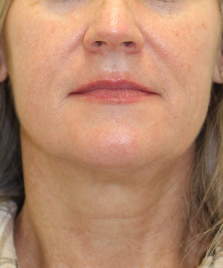 After Image: Sculptra - front