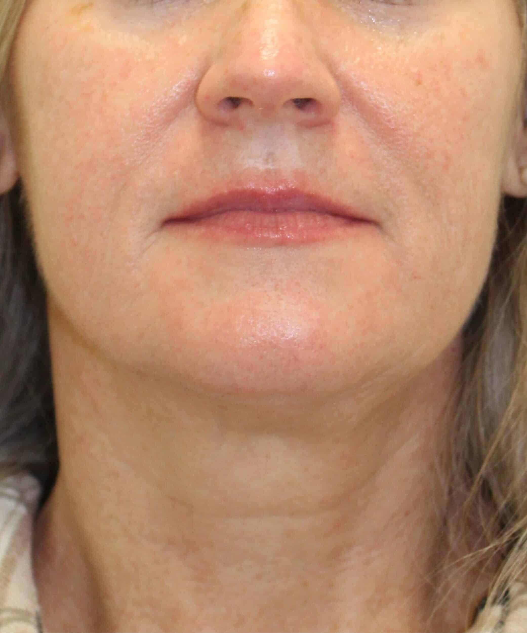After Image: Sculptra - front