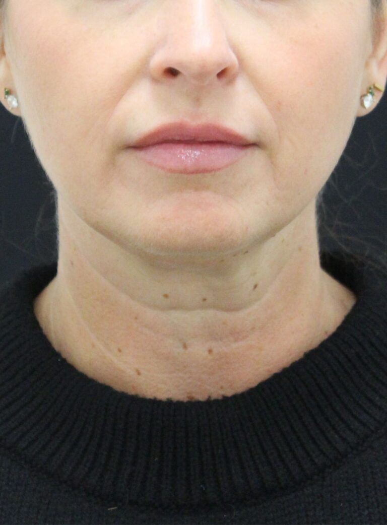 Before Image: Timeless Neck Protocol - front